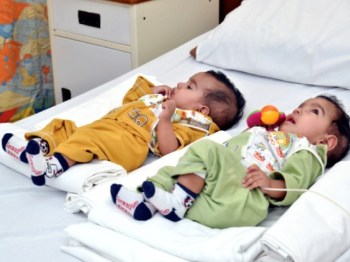 A rare and successful operation at the Aga Khan University Hospital, Pakistan: Conjoined twins separated through surgery