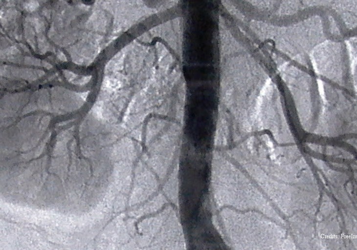 Simple public health intervention can preserve kidney health - Aga Khan University study