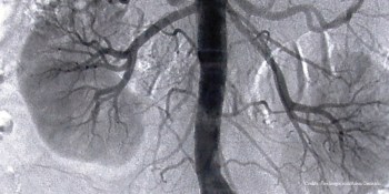 Simple public health intervention can preserve kidney health - Aga Khan University study